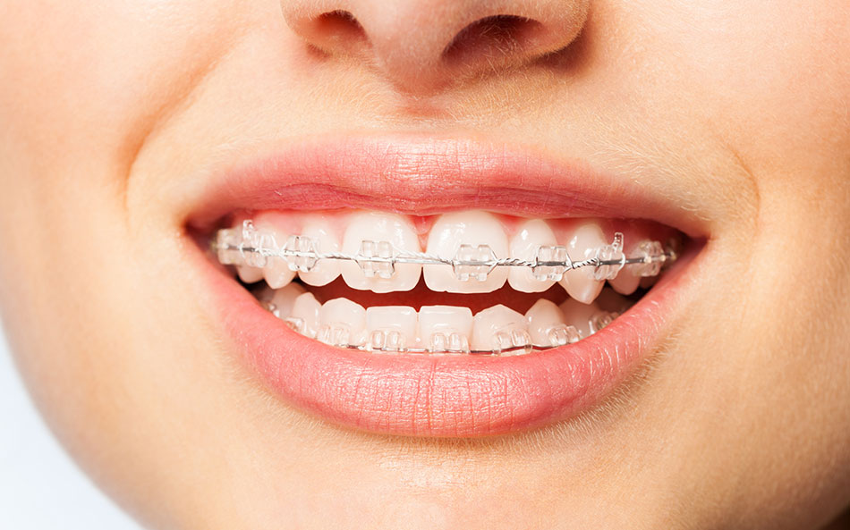 Bracket Estetici Image