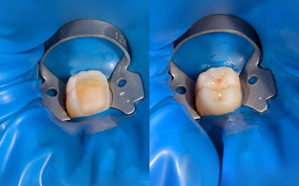 Intarsio Dentale Image