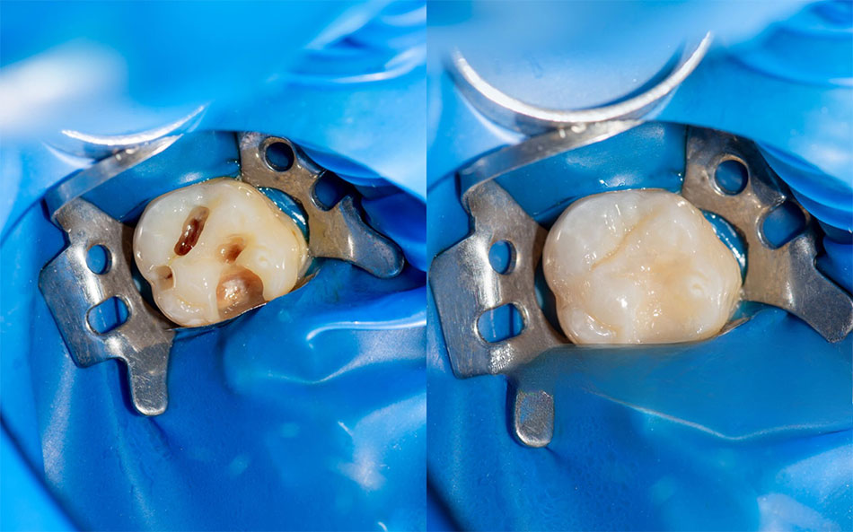 Otturazione Estetica Image
